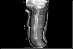 broken femur cast off 4-8-2011 (1)