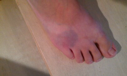 reddish spots on feet