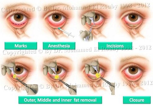 define blepharoplasty