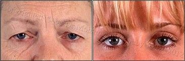 define blepharoplasty