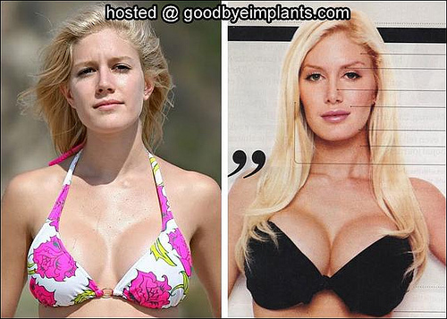 heidi montag before and after 10. heidi montag before after.