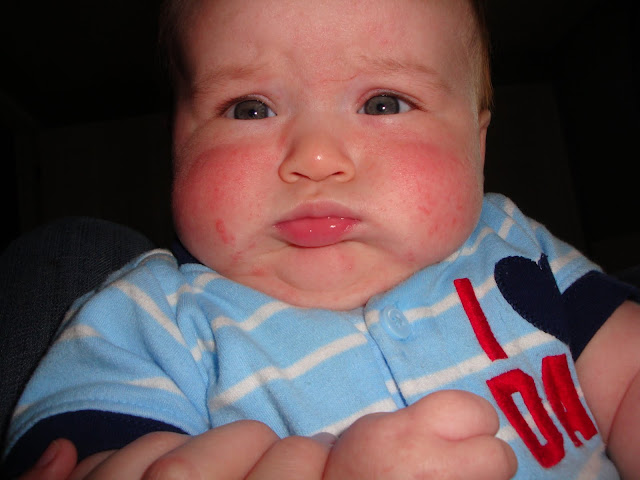 rice cereal allergy? BabyCenter