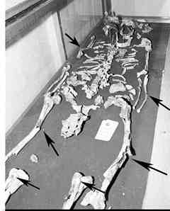 Bones of Philip II or III with arrows pointing to areas researchers say are warped from cremation. 