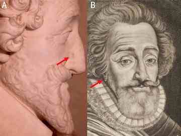 Sculptures and paintings of Henry IV show a mole on his nose and an earring in his right ear. Credit: Philippe Charlier/British Medical Journal.