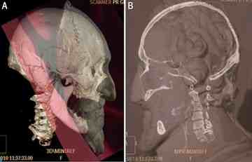 In this overlay image, the mummified skull matches sculptures of Henry IV's head. Credit: Philippe Charlier/British Medical Journal.