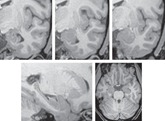 amygdala-brain-scans