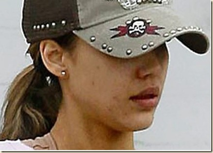 jessica_alba_acne