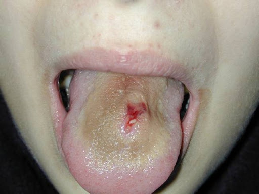 infected tongue piercings. (an infected tongue piercing