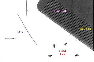 Nits  and Lice