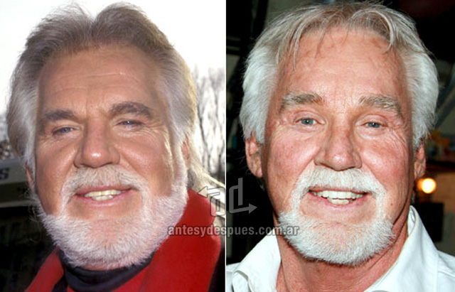 kenny rogers before surgery