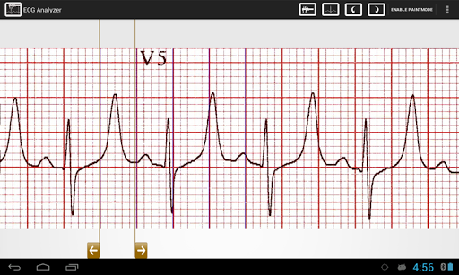 ECG Analyzer