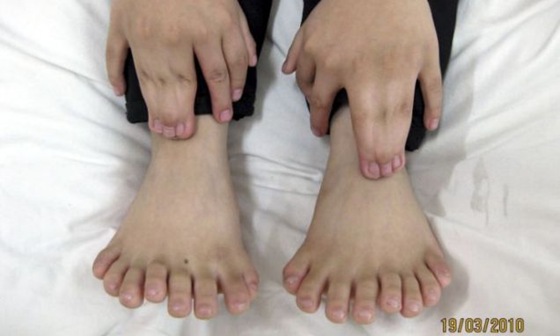 Boy With Record 31 Fingers and Toes