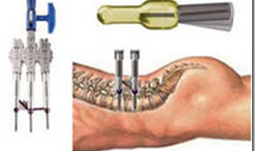 Implantes Percutáneos, la Novedad en Cirugía de Espalda