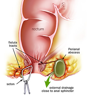 PUDIN TTG: Perianal Abcess/Fistula: Satu Pembedahan