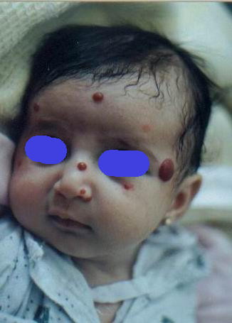 Blueberry muffin baby: A pictoral differential diagnosis ...