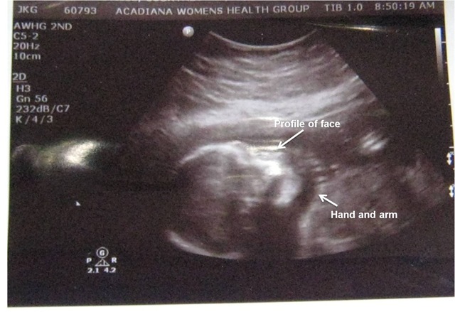 [ultrasound2[3].jpg]