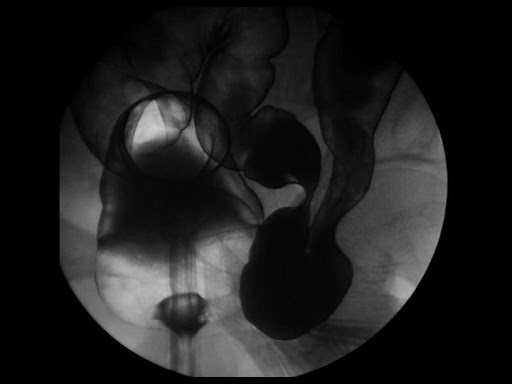 Hernias In Women Pictures. Get more men than women