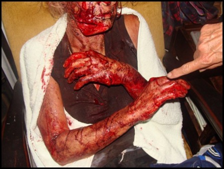 Eksteen Theresa Jan 25 2010 Stilfontein panga attack victim serious in hospital pic Elria van Schalkwyk Facebook