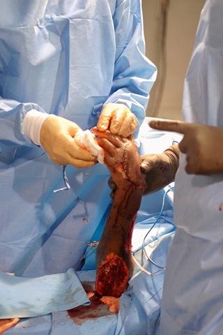 [Marc Dorce arm in surgery[2].jpg]