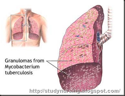 miliary-tuberculosis