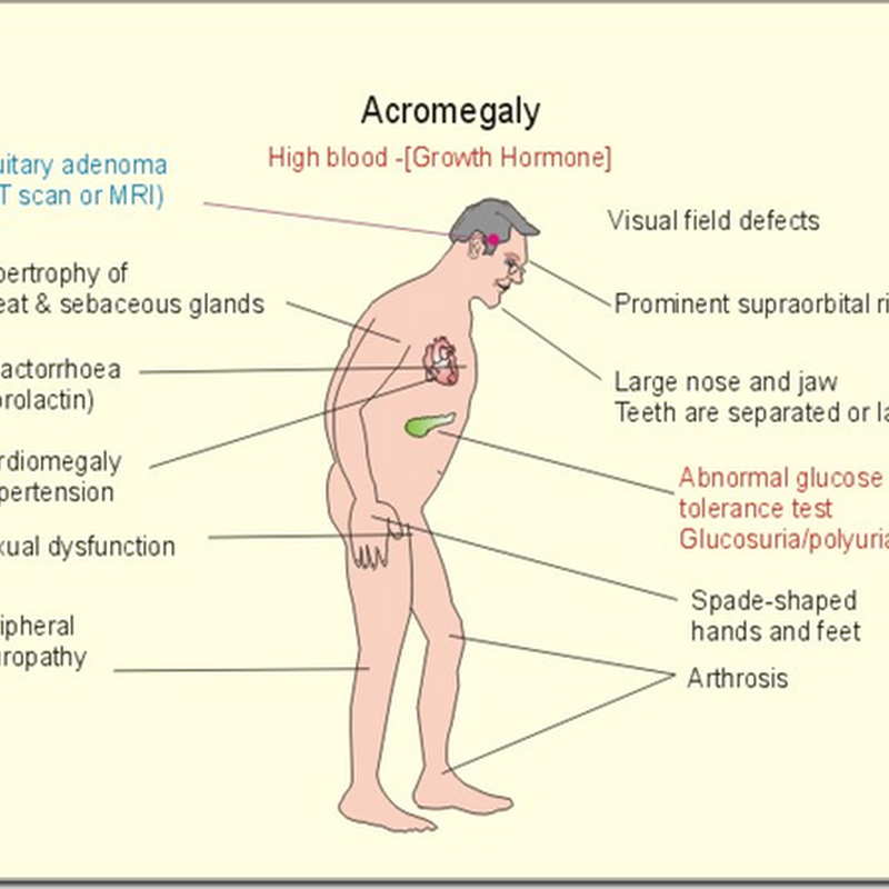 ENDOCRINOLOGY-Acromegaly: symptoms