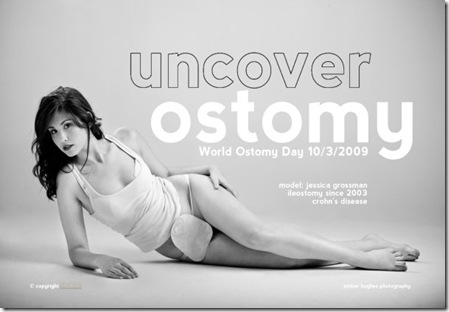 uncover ostomy