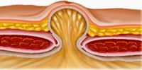 Umbilical hernia    