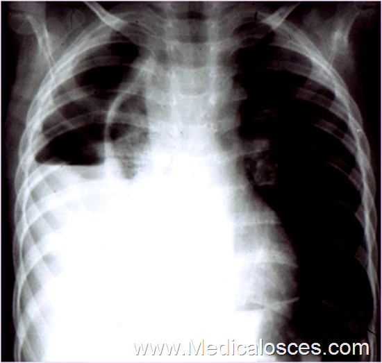 Comment on this chest X-ray ? plez explain your answer 