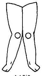 图 2  - X 型腿