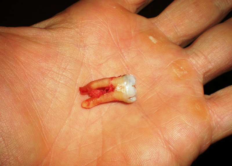 [tooth[2].jpg]