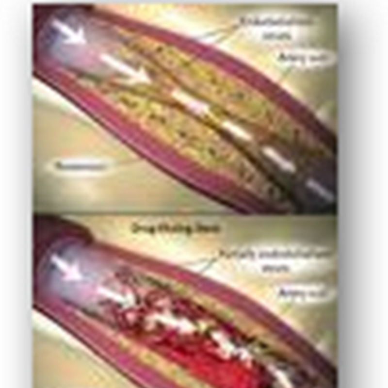 J and J Gets 1.7 Billion Wins Battle, Doctors, Hospitals and Patients Lose on the High Cost of “Legally” Patented Stents