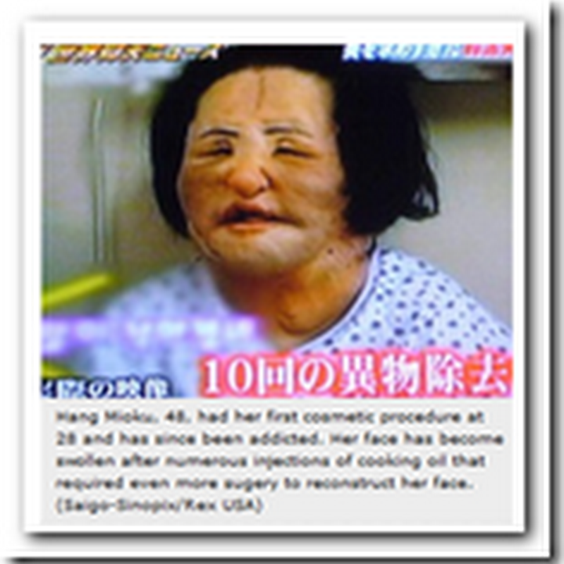 Woman uses cooking oil as a replacement for silicone injections - Korea