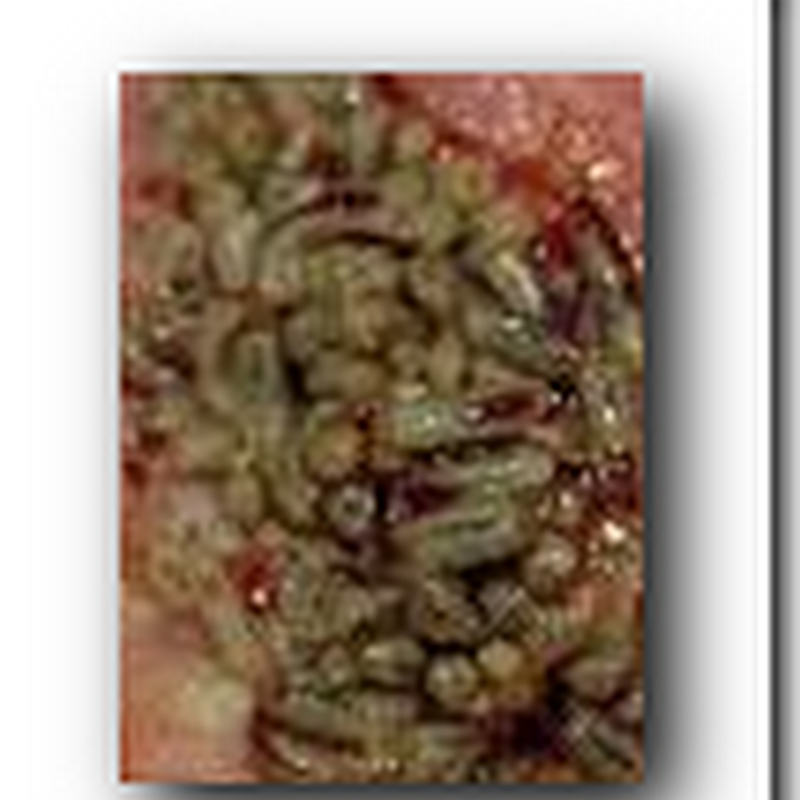 Is there a CPT Code for Maggots Yet?