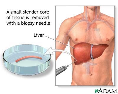 [liver-biopsy[4].jpg]