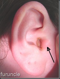 furuncle ear