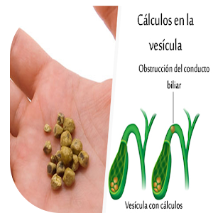 Download Gallstones Disease Google Play softwares - abJ07EO7veoL | mobile9