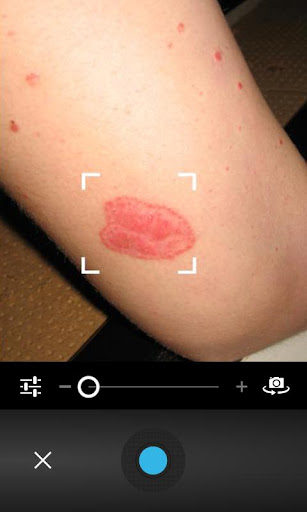 【免費健康App】Psoriasis Photo Diary-APP點子