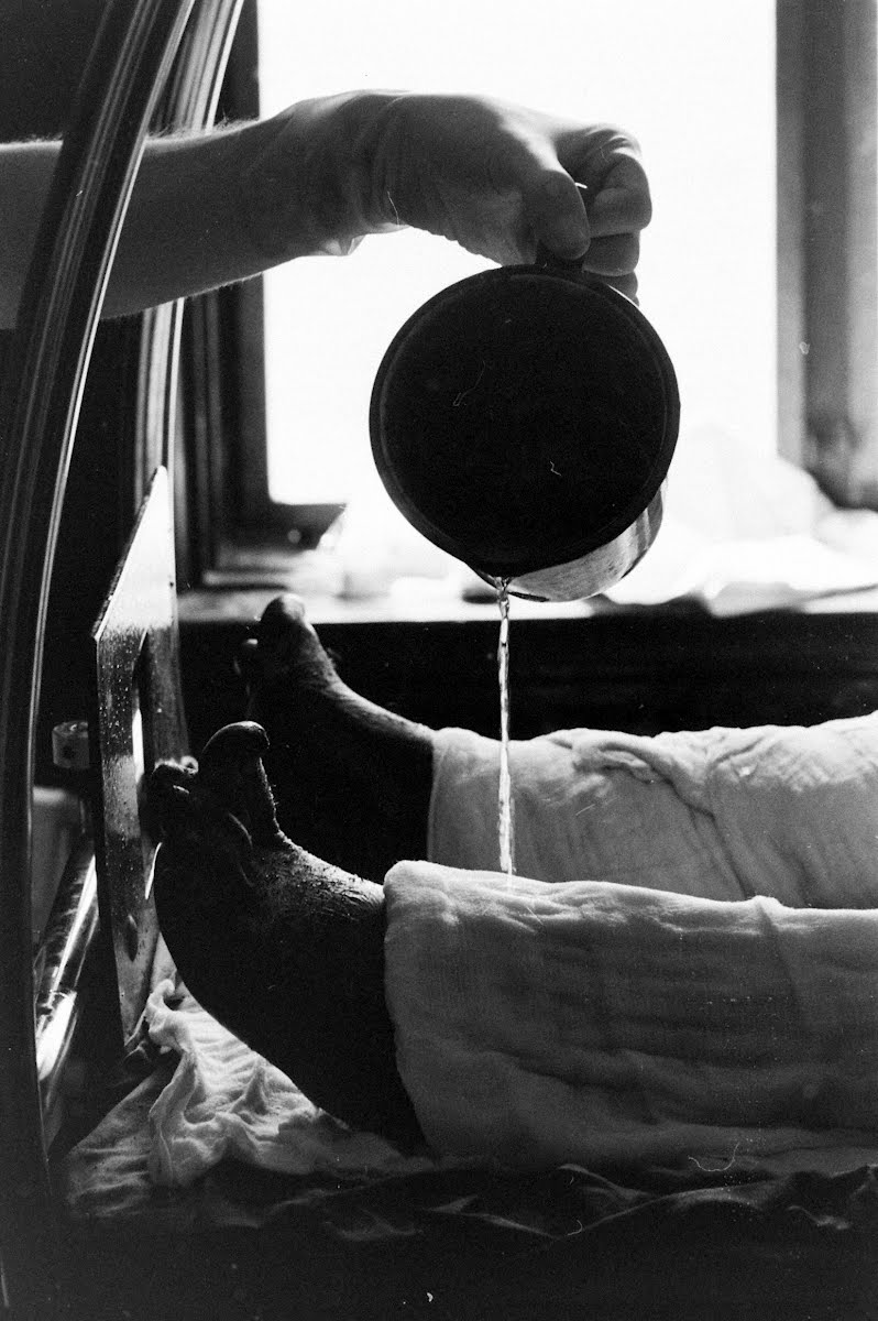 Silver Nitrate Burn Treatment John Leongard — Google Arts & Culture