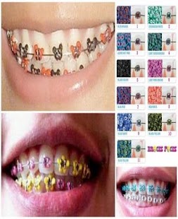 Make Fake Braces