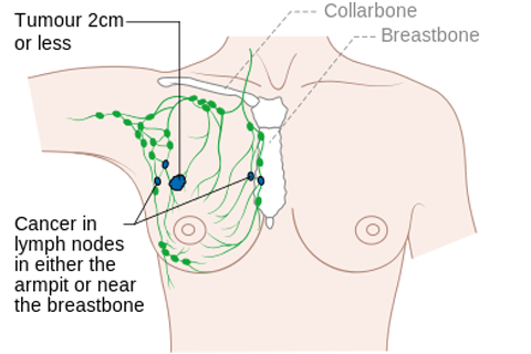 Signs of Breast Cancer