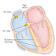 Cardiac Arrhythmia & Treatment APK