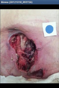 Android application MOWA – Wound Care Solution screenshot