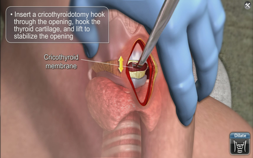 【免費醫療App】Medrills: Cricothyroidotomy-APP點子